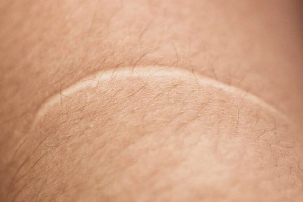 Sẹo trắng là loại sẹo xuất hiện trong quá trình phục hồi vết thương trên da