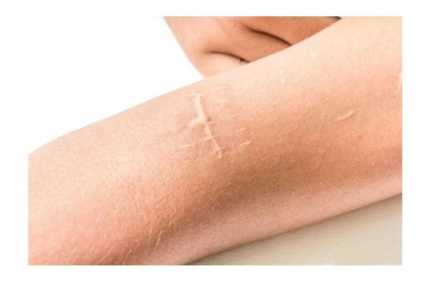 Sẹo thường xuất hiện ở các vị trí có da căng bóng