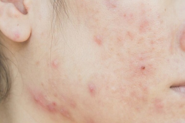 Mụn trứng cá là một trong những nguyên nhân gây ra sẹo trắng