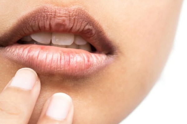 Tại sao môi thâm? Môi thâm do di truyền rất khó hết nếu như không có sự can thiệp của các phương pháp khử thâm công nghệ cao