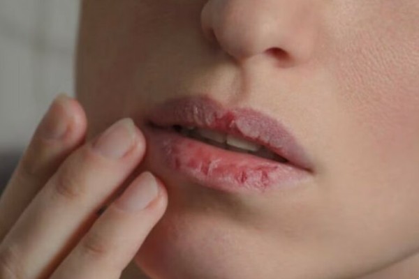 Đôi môi thâm sạm, khô, nứt nẻ chủ yếu đến từ việc không uống đủ nước hàng ngày