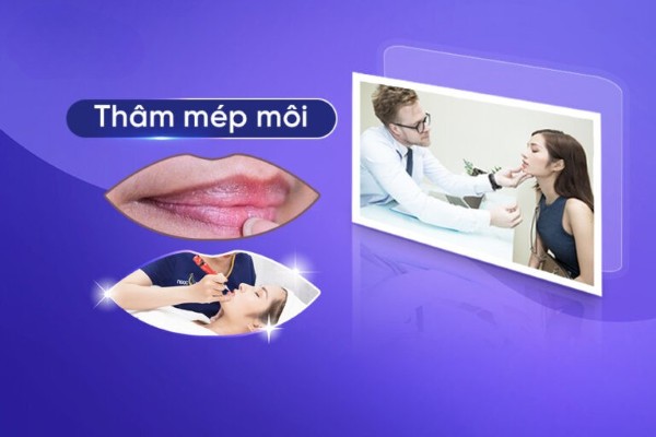Tại sao mép miệng bị thâm? 7 Cách trị thâm mép môi hiệu quả