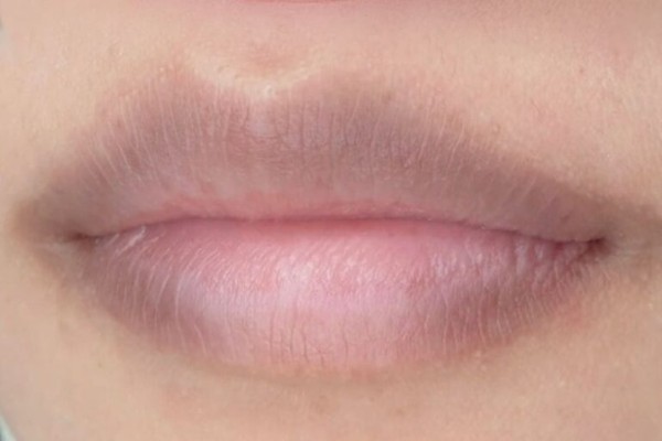 Khóe môi bị thâm do nhiều nguyên nhân khác nhau, từ tác dụng phụ của thuốc, tiếp xúc với ánh nắng mặt trời, di truyền, tuổi tác, bệnh lý cho đến thói quen ăn uống