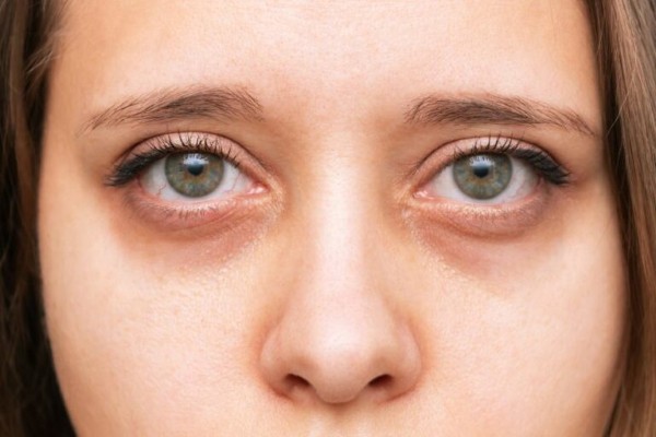 Vaseline có trị thâm mắt không? Các nguyên nhân gây thâm quầng mắt