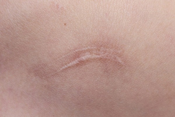 Sẹo lồi xuất hiện do sự rối loạn trong quá trình chữa lành vết thương