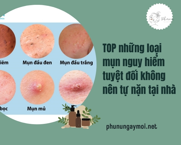 TOP những loại mụn nguy hiểm tuyệt đối không nên tự nặn tại nhà