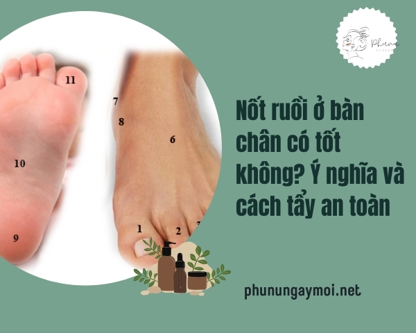 Nốt ruồi ở bàn chân