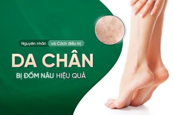 Da chân xuất hiện đốm nâu: Nguyên nhân và cách khắc phục hiệu quả