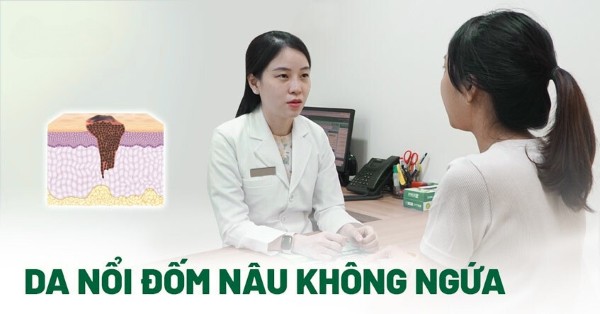 Da nổi đốm nâu không ngứa: Nguyên nhân và cách điều trị hiệu quả