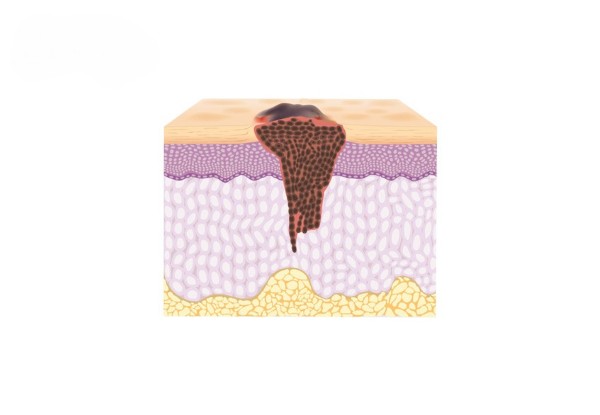 Da nổi đốm nâu không ngứa là gì?