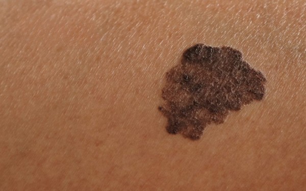 Xuất hiện đốm nâu trên da do thay đổi nội tiết tố