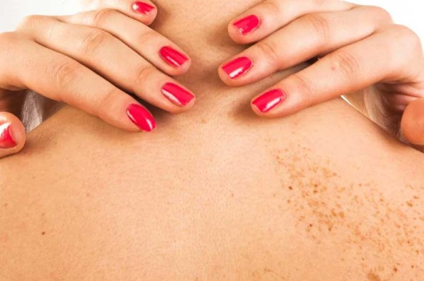 Một số nguyên nhân khác làm da nổi đốm nâu không ngứa