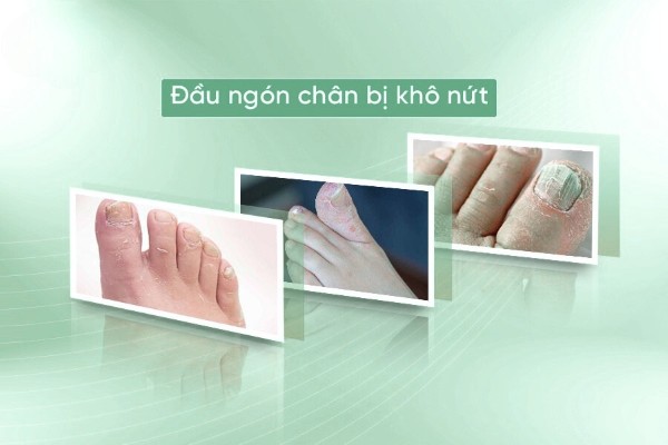 6 Cách trị đầu ngón chân bị khô nứt, tróc da hiệu quả ngay tại nhà