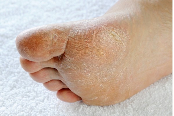 Đầu ngón chân bị không nứt thường không ảnh hưởng lớn đến sức khỏe