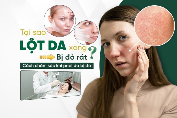 Tại sao lột da xong bị đỏ rát? Cách chăm sóc da sau peel đúng chuẩn
