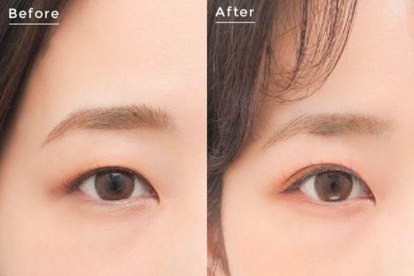 Các phương pháp hiện đại ngày nay có thể nhanh chóng tạo mắt 2 mí dễ dàng Các phương pháp hiện đại ngày nay có thể nhanh chóng tạo mắt 2 mí dễ dàng