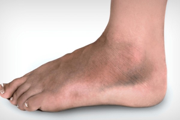 Thâm mắt cá chân là hiện tượng vùng da ở mắt cá chân bị tối màu