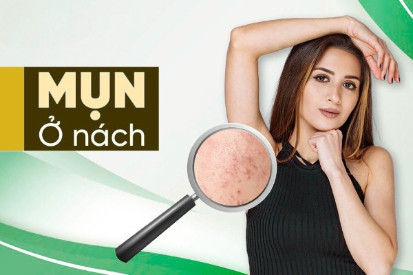 Mụn ở nách xuất hiện do đâu? 5 cách trị mụn nách hiệu quả nhất