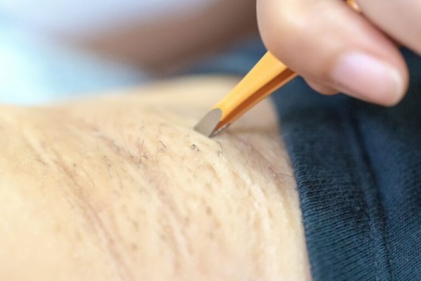 Lông mọc ngược