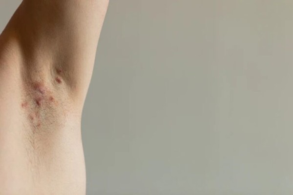 Viêm da dị ứng ở vùng nách