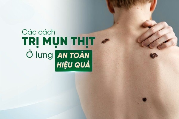 Mụn thịt ở lưng: Dấu hiệu nhận biết, nguyên nhân và cách điều trị