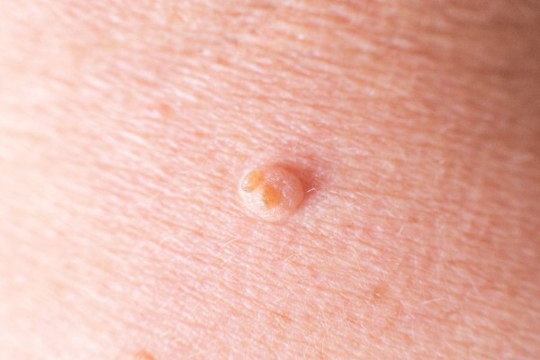 Các dấu hiệu nhận biết mụn thịt ở lưng cực đơn giản