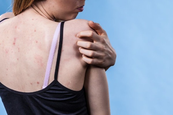 Nếu bố hoặc mẹ mắc phải tình trạng mụn thịt, tỷ lệ con cái mắc phải cũng sẽ cao hơn