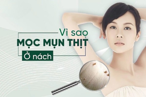 Nguyên nhân mọc mụn thịt ở nách và cách xử lý an toàn tại nhà
