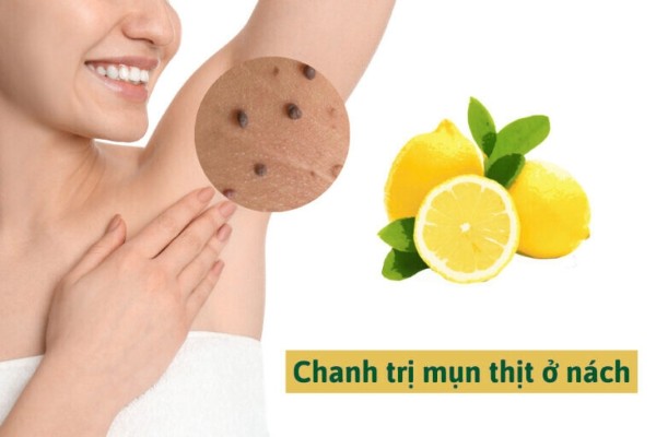 Điều trị mụn thịt ở nách bằng nước chanh
