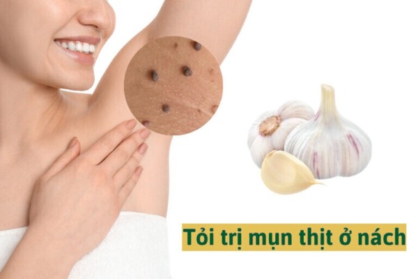 Chữa mụn thịt vùng nách tại nhà bằng tỏi