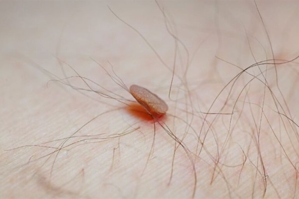 Nách nổi mụn thịt có nguy hiểm không?