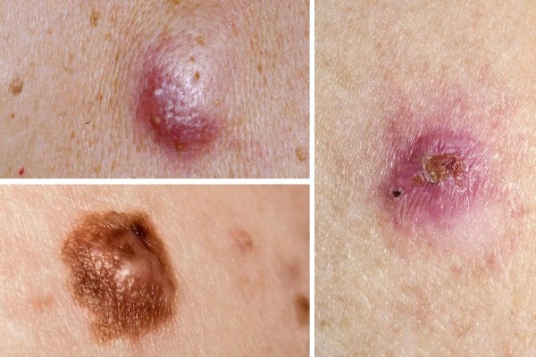 Mụn ác tính – TOP những loại mụn nguy hiểm, tuyệt đối không điều trị tại nhà