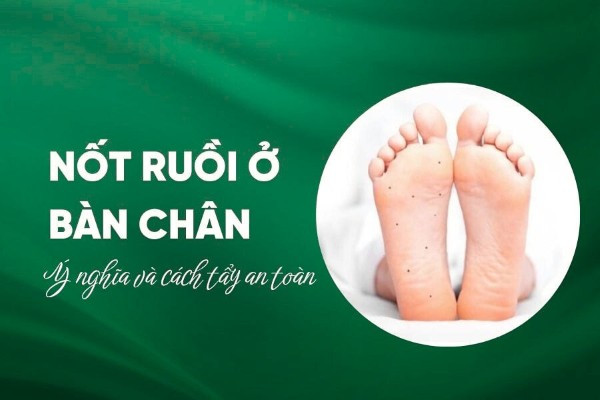 Nốt ruồi ở bàn chân có tốt không? Ý nghĩa và cách tẩy an toàn
