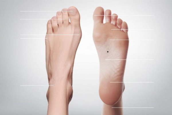Nốt ruồi ở bàn chân là sự tập hợp của các tế bào sắc tố trên da