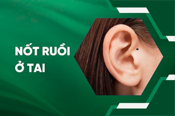 Nốt ruồi ở tai: Ý nghĩa theo từng vị trí và tổng quan chi tiết