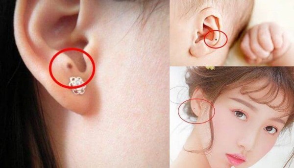 Nốt ruồi ở tai có nguy hiểm không?