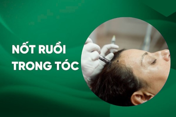 Nốt ruồi trong tóc có ý nghĩa gì? Giải mã theo nhân tướng học