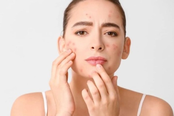 Bia chứa cồn nên có thể làm da dễ bị kích ứng và trở nên nhạy cảm hơn