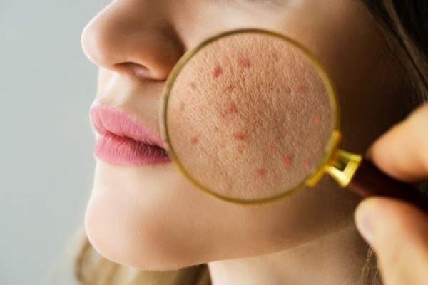 Tình trạng kích ứng nổi mụn trên da cũng là một tác hại của mặt nạ khoai tây sữa tươi rõ rệt