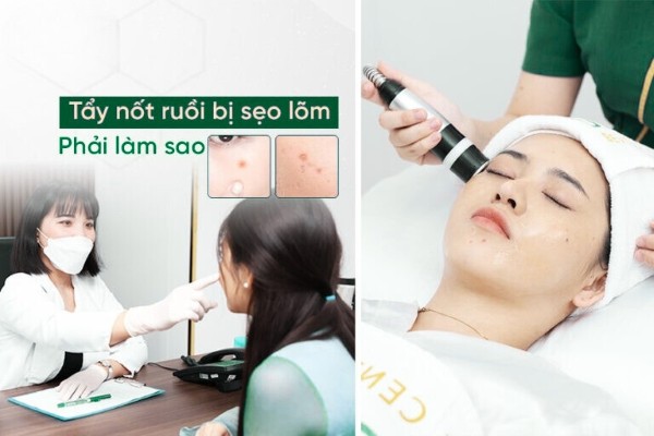 Tẩy nốt ruồi bị sẹo lõm: Nguyên nhân và cách điều trị hiệu quả Tẩy nốt ruồi bị sẹo lõm: Nguyên nhân và cách điều trị hiệu quả