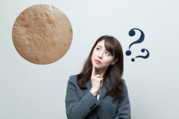 Việc tẩy nốt ruồi không đúng cách có thể dẫn đến sự hình thành sẹo lõm sẹo rỗ trên da. Việc tẩy nốt ruồi không đúng cách có thể dẫn đến sự hình thành sẹo lõm sẹo rỗ trên da.