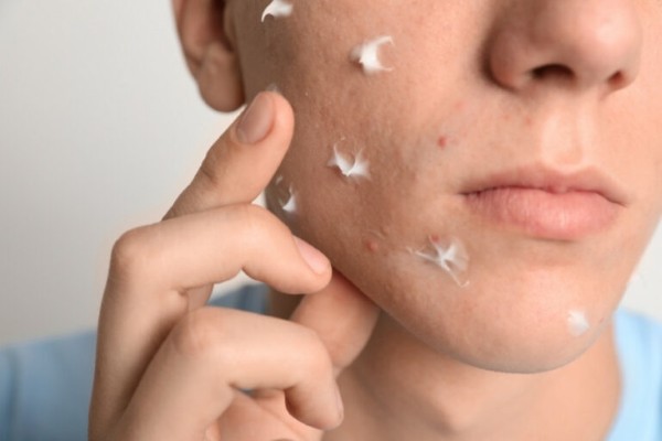 Tẩy nốt ruồi bị sẹo lõm phải làm sao? Sử dụng kem hoặc gel trị sẹo hiệu quả Tẩy nốt ruồi bị sẹo lõm phải làm sao? Sử dụng kem hoặc gel trị sẹo hiệu quả