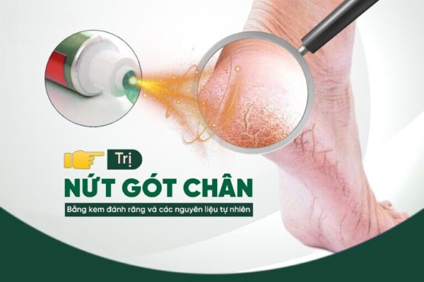 Trị nứt gót chân bằng kem đánh răng và 5 nguyên liệu dễ tìm