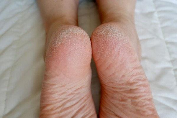 Tình trạng gót chân bị khô cứng nứt nẻ xuất phát từ nhiều nguyên nhân khác nhau