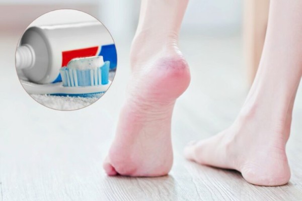 Hướng dẫn cách trị nứt gót chân bằng kem đánh răng