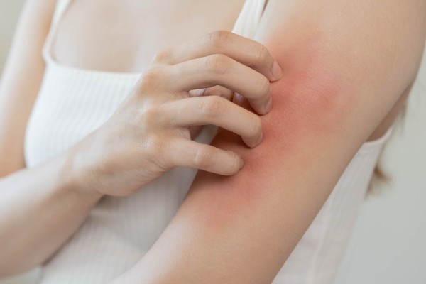 Cải thiện tình trạng ngứa, mề đay với lá tía tô