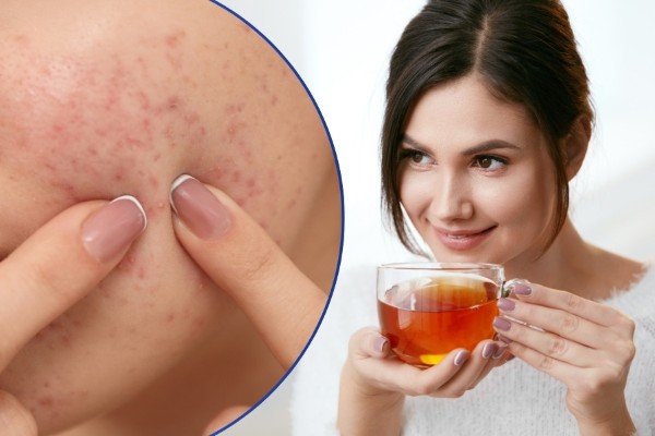 Thực hư chuyện uống trà có nổi mụn không?