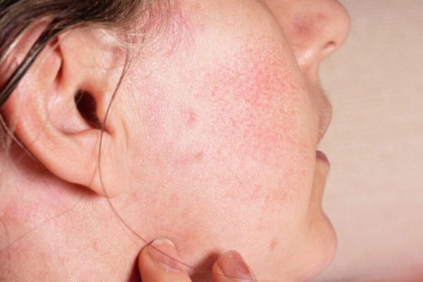 Xông hơi mặt bằng lá tía tô giúp ngừa viêm, giảm kích ứng