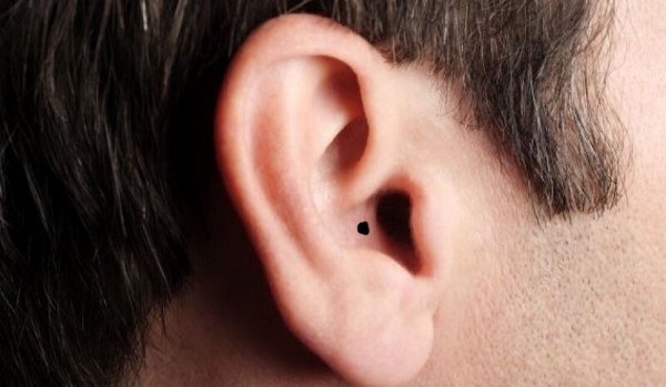 Nốt ruồi ở trong tai