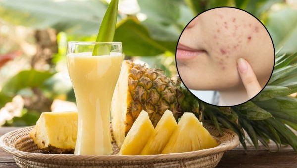 Ăn dứa có nổi mụn không? Lợi ích của dứa đối với làn da mụn Ăn dứa có nổi mụn không? Lợi ích của dứa đối với làn da mụn